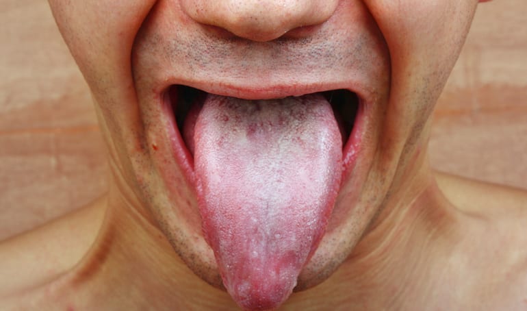 AB Hormone Therapy Bryan/College Station, Texas - 2 - Mouth and Tongue Image