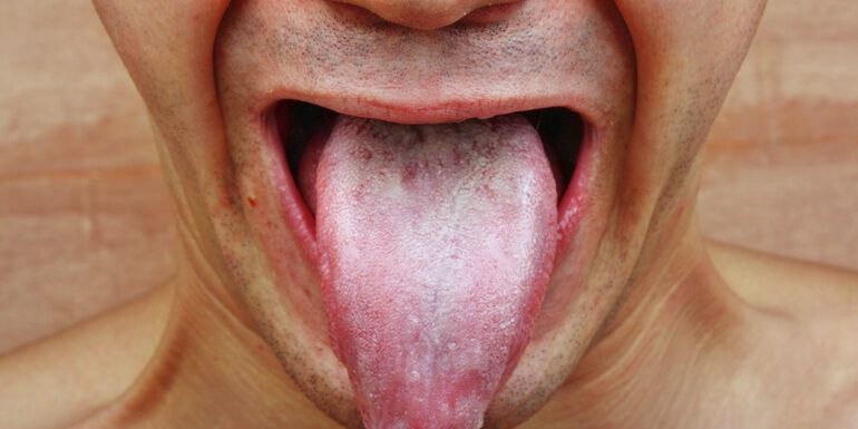 AB Hormone Therapy Bryan/College Station, Texas - 2 - Mouth and Tongue Image