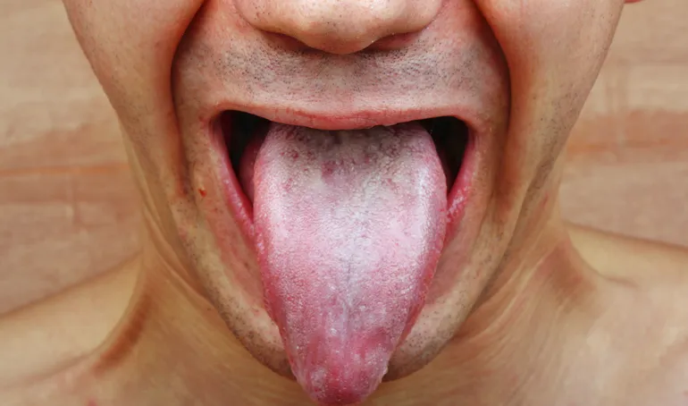 AB Hormone Therapy Bryan/College Station, Texas - 2 - Mouth and Tongue Image